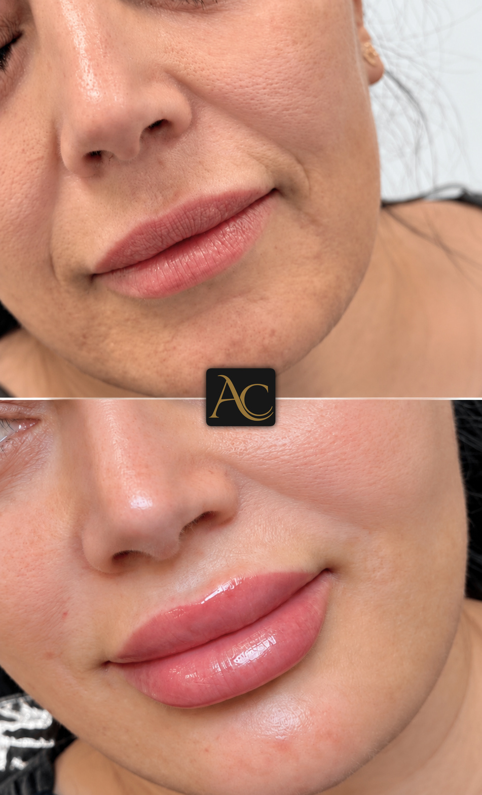 Before and after results at Aesthete Clinic Harlow, client one