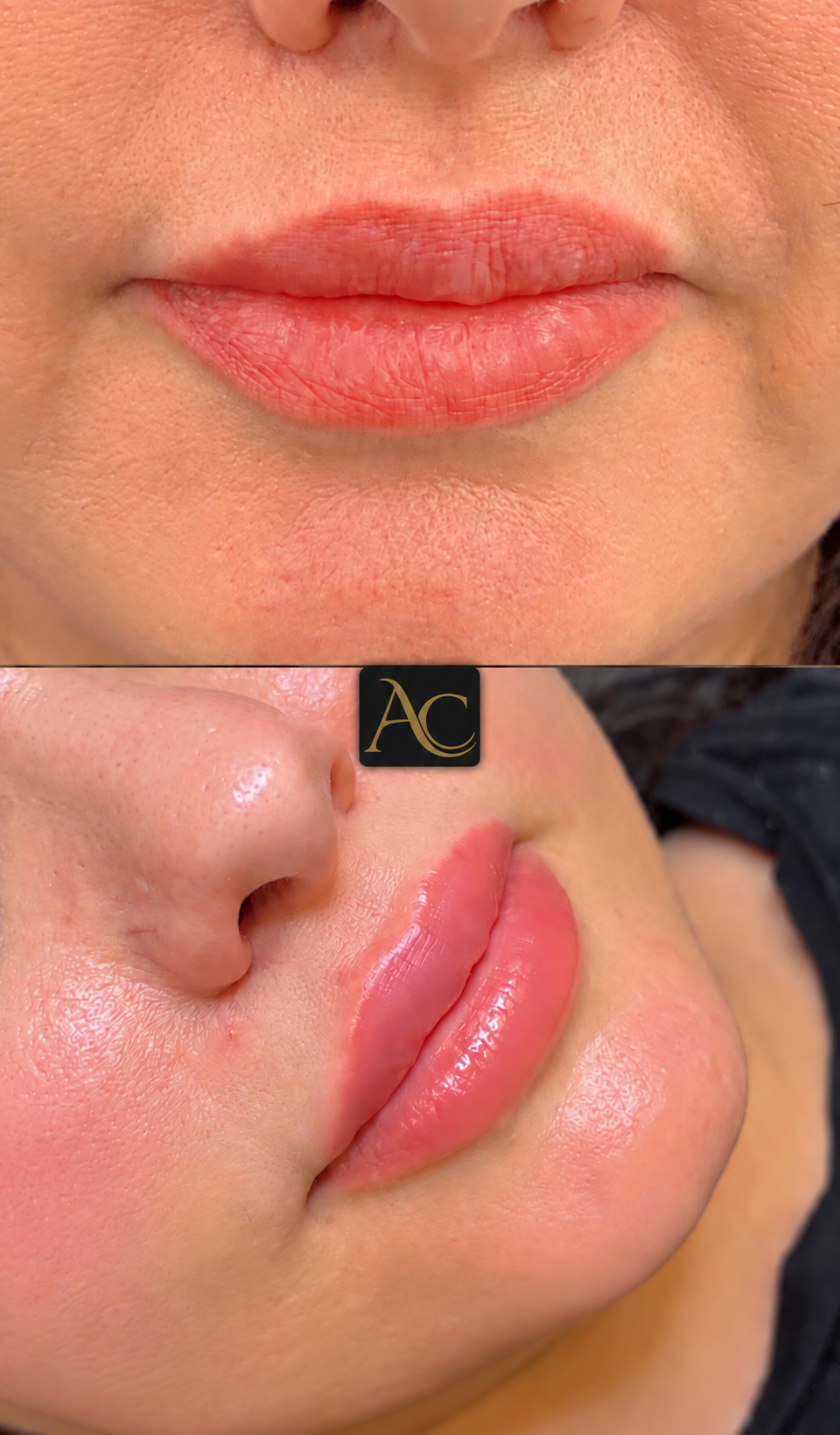 Before and after results at Aesthete Clinic Harlow, client two