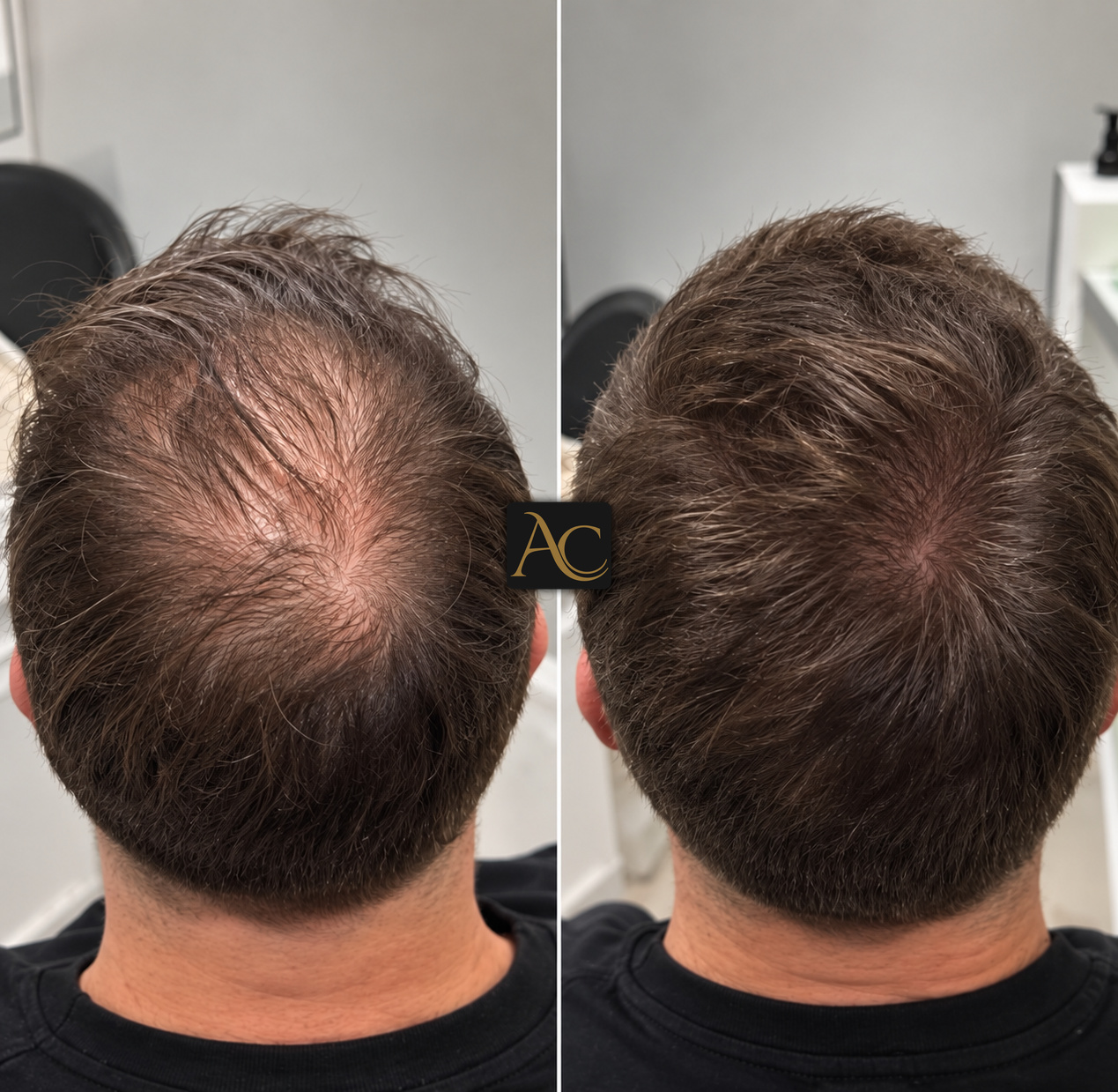 Before and after results at Aesthete Clinic Harlow, client three