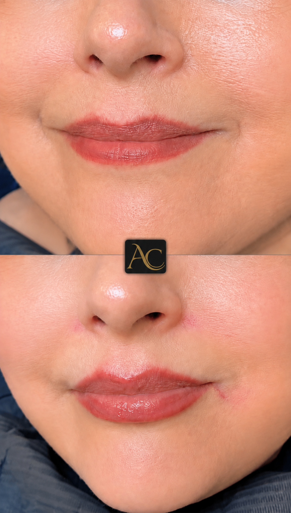 Before and after results at Aesthete Clinic Harlow, client four