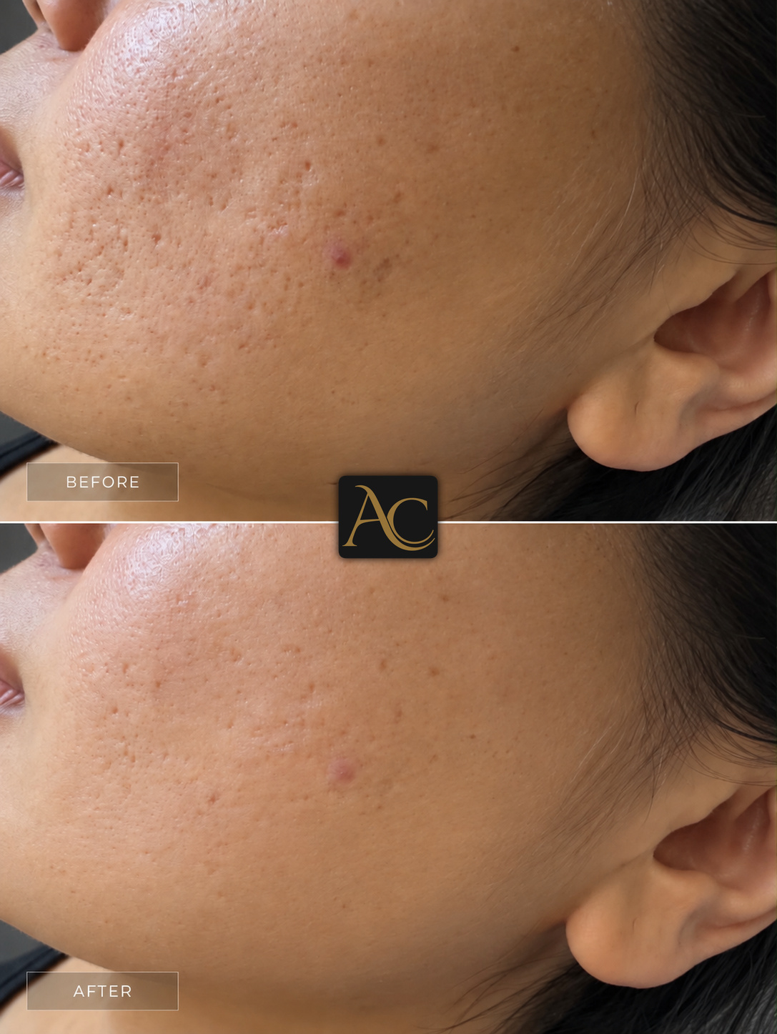 Before and after results at Aesthete Clinic Harlow, client five