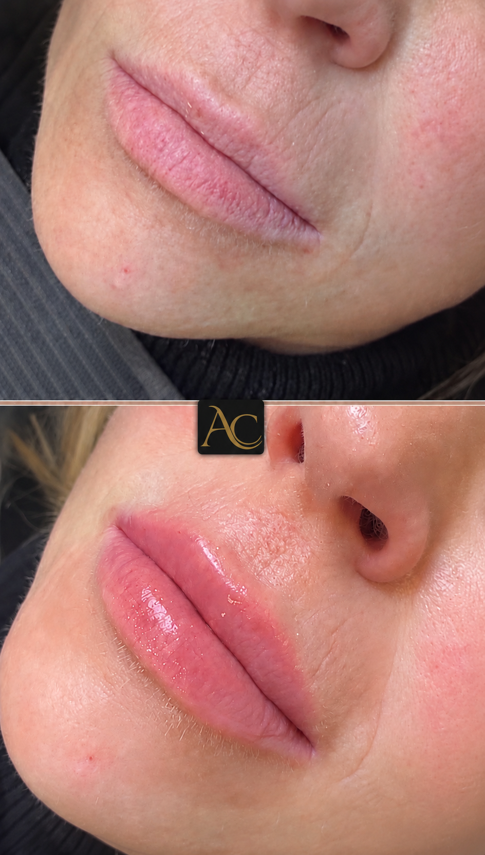 Before and after results at Aesthete Clinic Harlow, client six