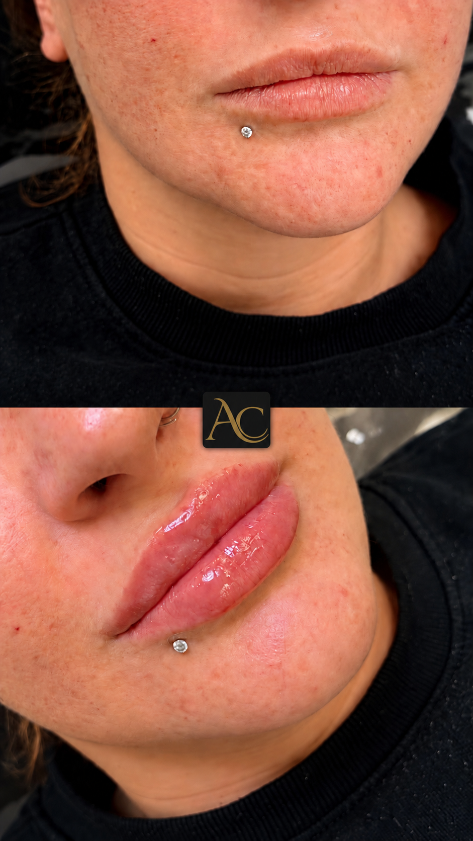 Before and after results at Aesthete Clinic Harlow, client seven