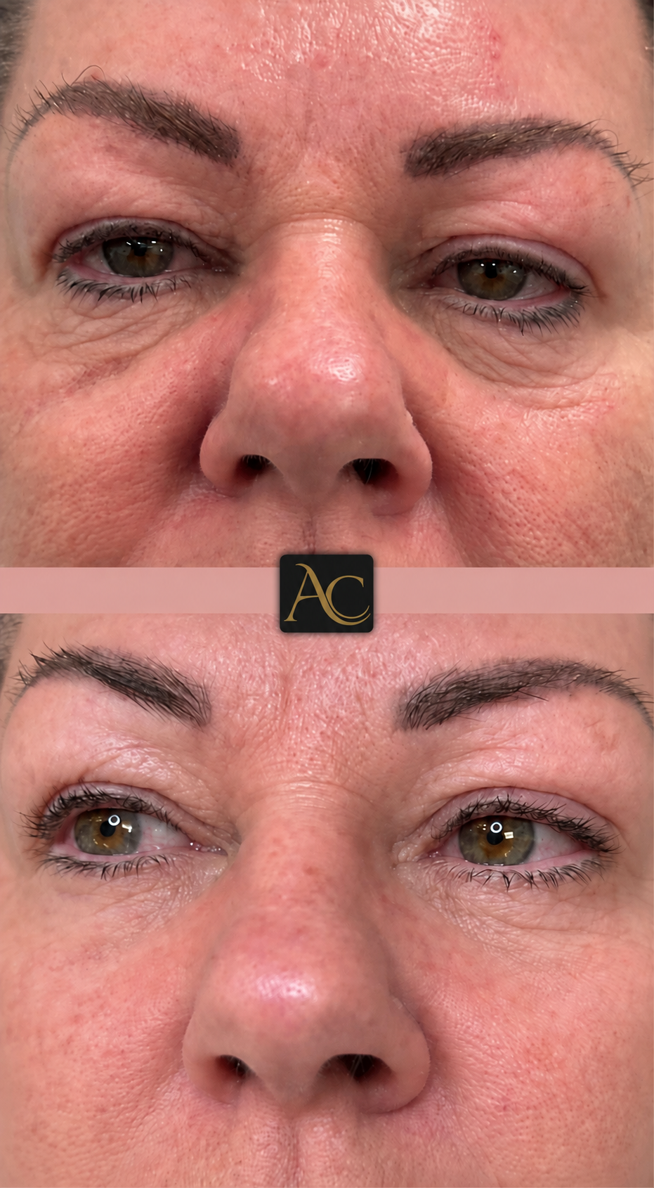 Before and after results at Aesthete Clinic Harlow, client eight