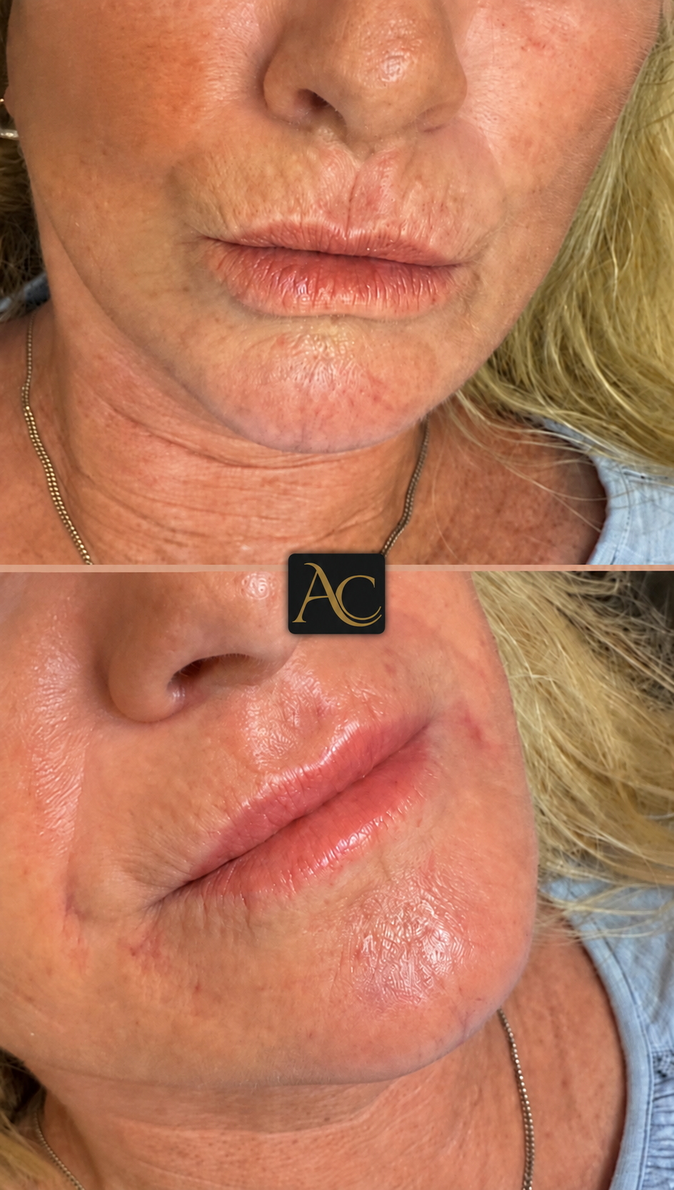 Before and after results at Aesthete Clinic Harlow, client ten