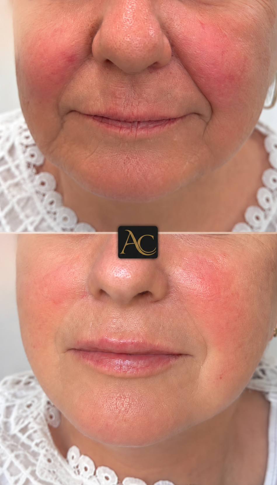 Before and after results at Aesthete Clinic Harlow, client eleven