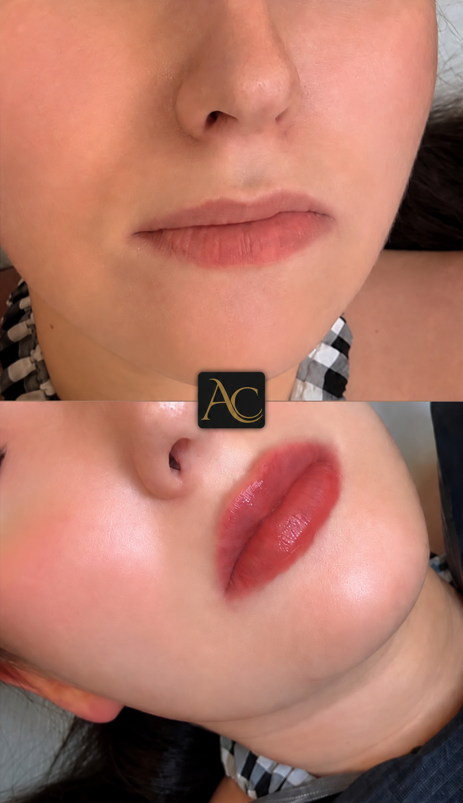 Before and after results at Aesthete Clinic Harlow, client twelve